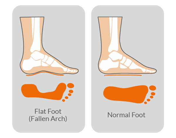 Flat feet G1