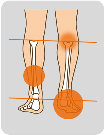 Flat feet G2