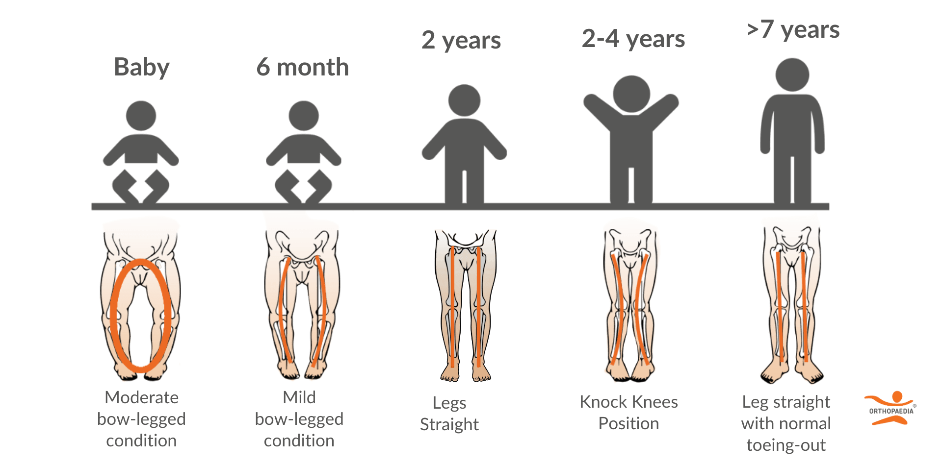 Knock Knee Diagram