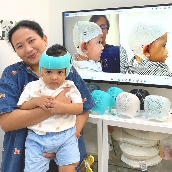 Gevarel Family - Combination Mild Brachycephaly & Right Plagiocephaly